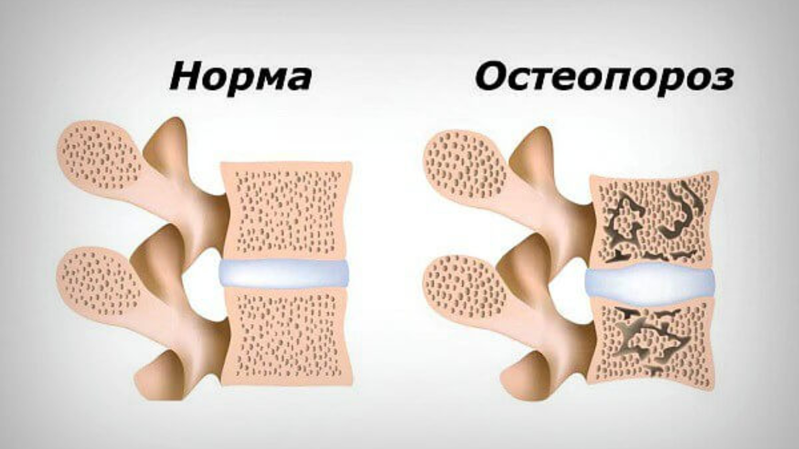 Улучшает кости. Остеопороз. Остеопороз кость. Кость при остеопорозе. Остеопороз картинки.