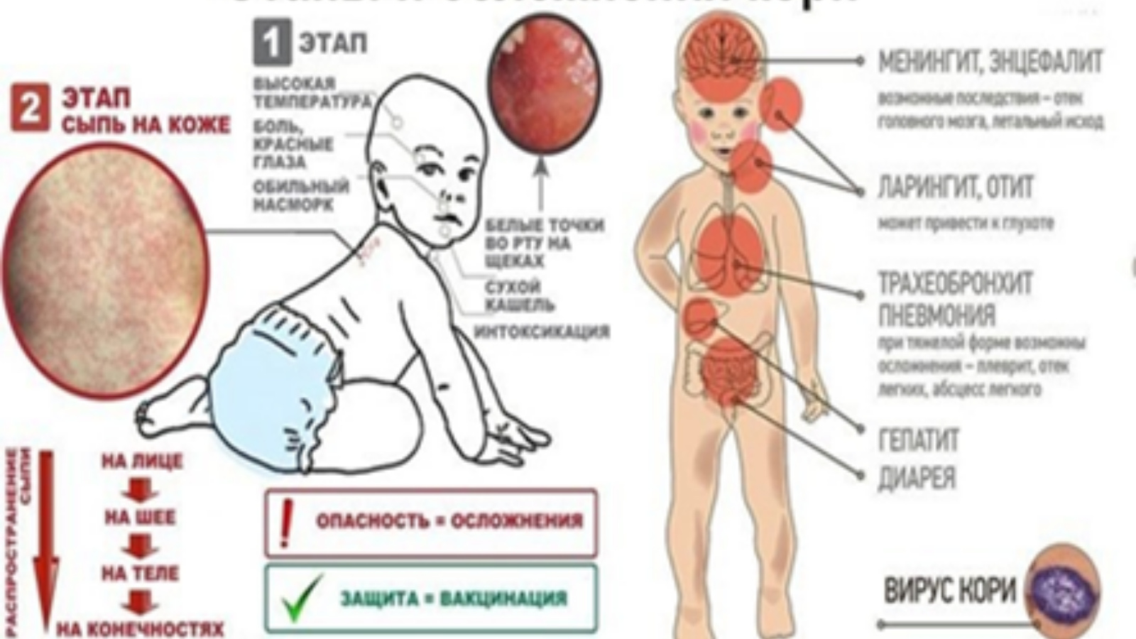 Сколько дней держится корь у детей. Клинические проявления кори у детей. Коревая краснуха пятна. Корь основные клинические симптомы.